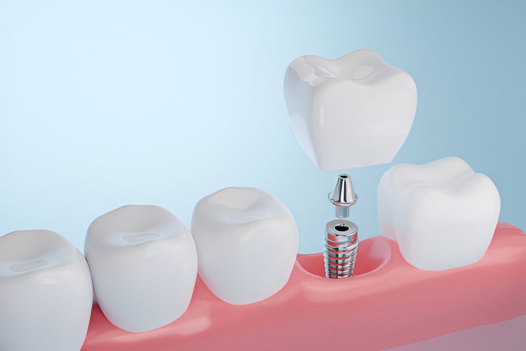 Dental implant model displaying components used in dental implants in Keswick.