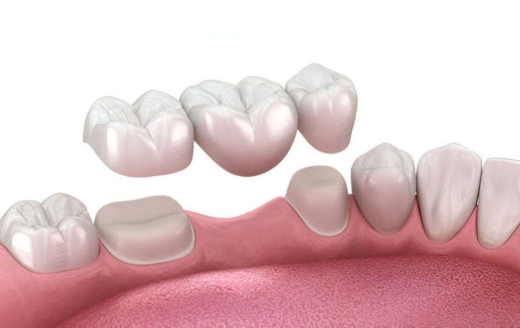 Dental bridge with three porcelain teeth between natural teeth at a dental clinic in Keswick.