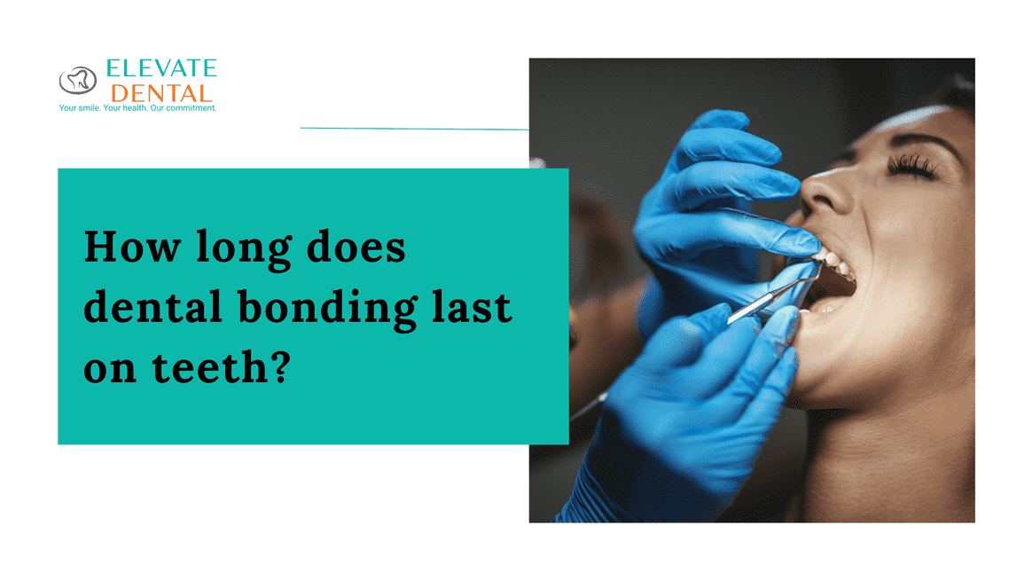 How long does dental bonding last on teeth?