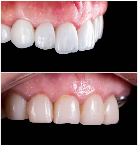 dental implants in sw edmonton what to expect during treatment