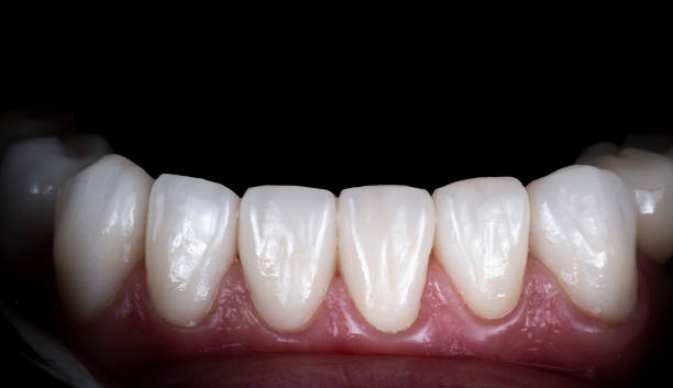 does dental bonding fix gaps between teeth