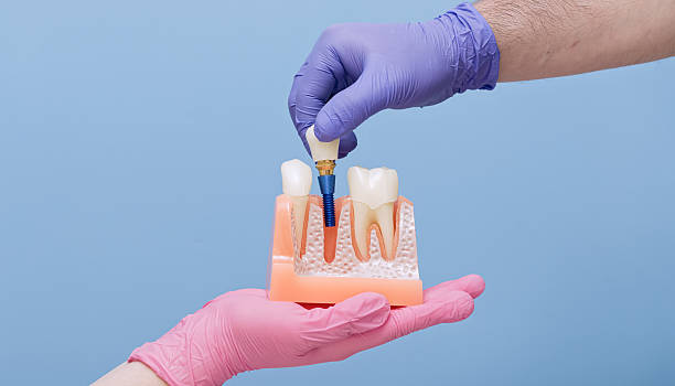 how long does the dental implant process take